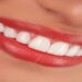 Composite Veneers Turkey: What Should You Know Before Treatment?