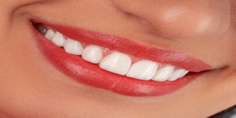 Composite Veneers Turkey: What Should You Know Before Treatment?